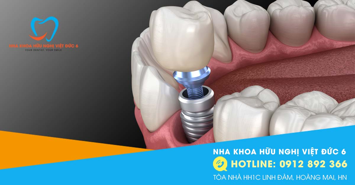 5 bước trong quy trình trồng răng Implant Nha Khoa Việt Đức 6