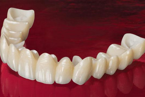 Cầu sứ Cercon gắn ốc vít – Thẩm mỹ tự nhiên, độ bền cao