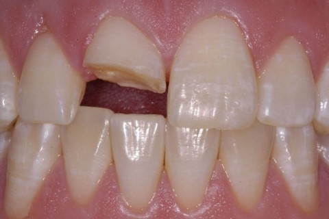 Chụp tủy bằng Hydroxit cãni