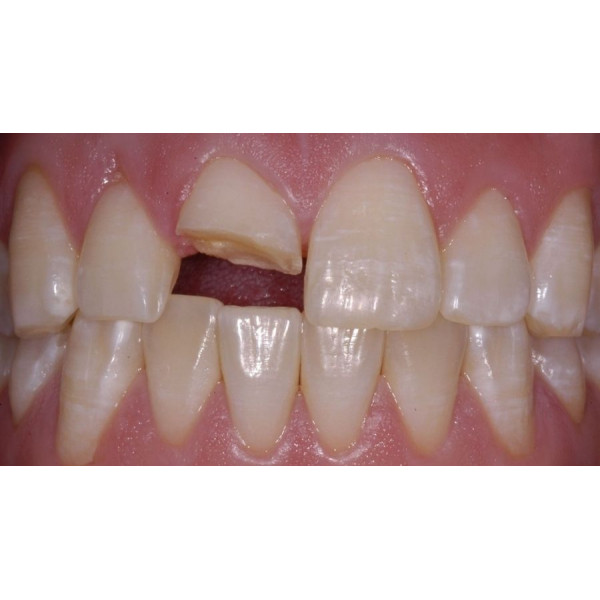 Chụp tủy bằng Hydroxit cãni