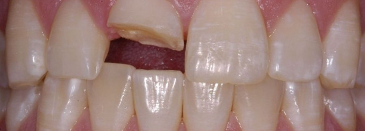 Chụp tủy bằng Hydroxit cãni