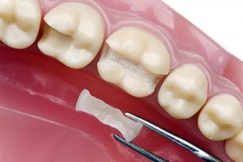 Phục hồi thân răng bằng Inlay/Onlay