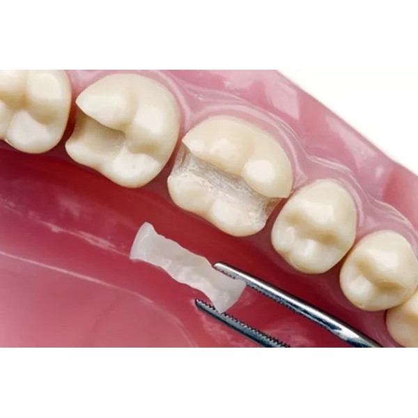 Phục hồi thânz răng bằng Inlay/Onlay