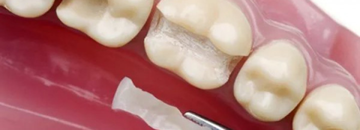 Phục hồi thân răng bằng Inlay/Onlay