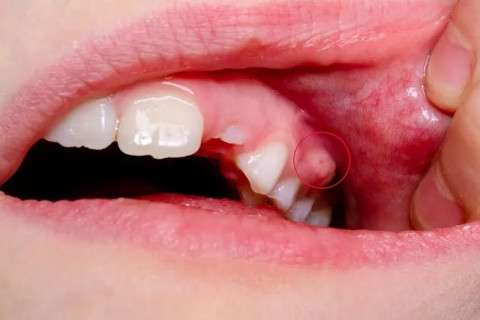 Điều trị áp xe quanh răng cấp - Giảm đau nhanh, ngăn biến chứng nguy hiểm