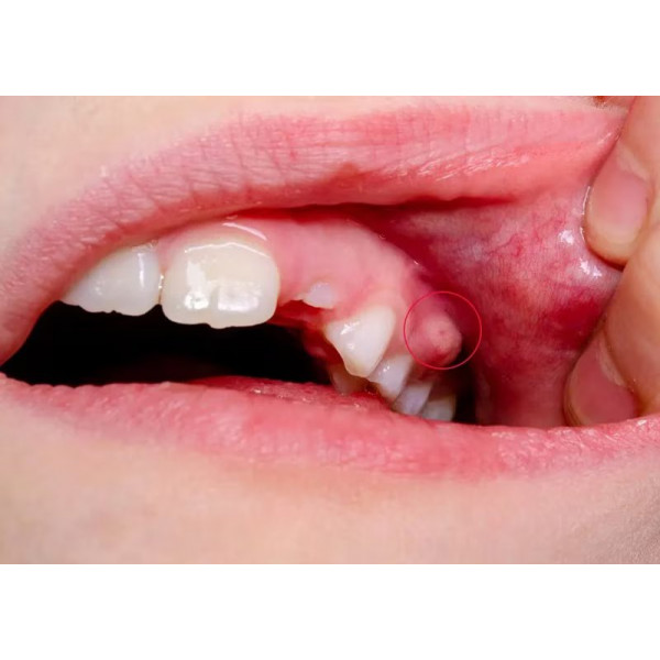 Điều trị áp xe quanh răng cấp - Giảm đau nhanh, ngăn biến chứng nguy hiểm