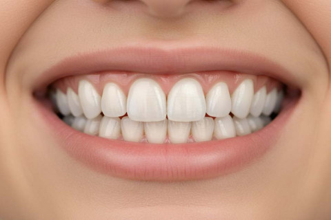 Tự tin tỏa sáng cùng nụ cười rạng rỡ nhờ bọc răng sứ cao cấp Tự tin tỏa sáng cùng nụ cười rạng rỡ nhờ bọc răng sứ cao cấp