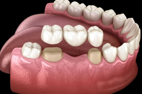 Cầu sứ toàn phần gắn ốc vít – Chuẩn cao cấp, đẹp như răng thật