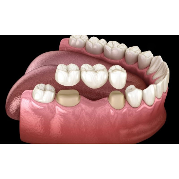 Cầu sứ toàn phần gắn ốc vít – Chuẩn cao cấp, đẹp như răng thật