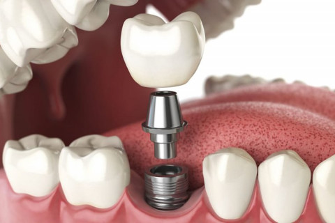 Cấy ghép Implant – Giải pháp phục hồi răng mất bền vững suốt đời