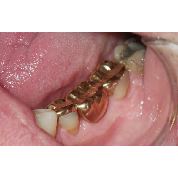 Chụp kim loại thường gắn ốc vít - phục hồi răng bền chắc