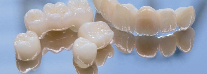 Chụp sứ toàn phần là gì và khác gì với các phục hình thông thường?