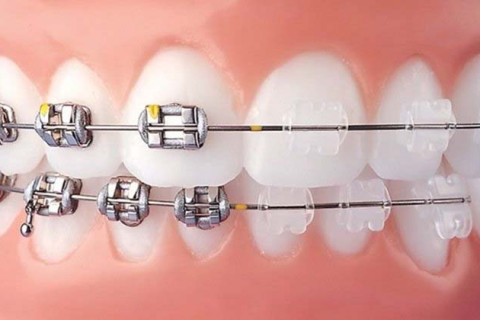 Liên kết cố định răng lung lay bằng dây cung kim loại và Composite