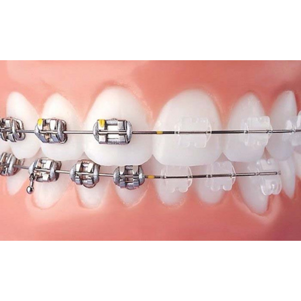 Liên kết cố định răng lung lay bằng dây cung kim loại và Composite