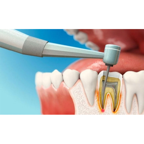  Chấm dứt đau nhức – Giữ lại răng thật với điều trị tủy không đau