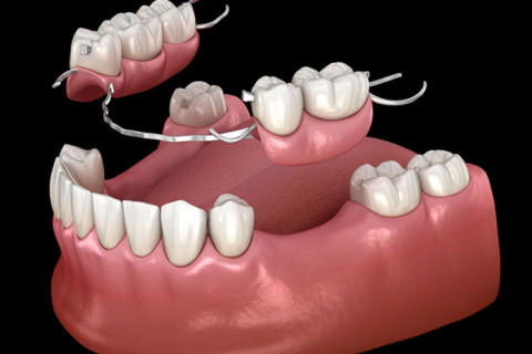 Hàm tháo lắp toàn phần nhựa dẻo – lựa chọn nhẹ nhàng, thẩm mỹ tuyệt đối