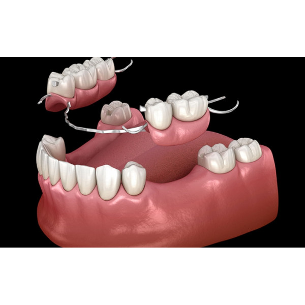 Hàm tháo lắp toàn phần nhựa dẻo – lựa chọn nhẹ nhàng, thẩm mỹ tuyệt đối