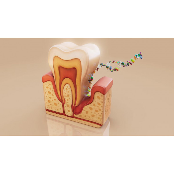 Điều trị nhạy cảm ngà bằng máng với thuốc chống ê buốt