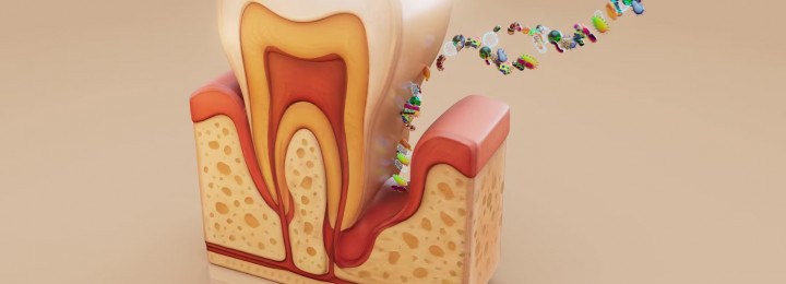 Điều trị nhạy cảm ngà bằng máng với thuốc chống ê buốt