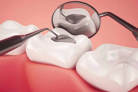 Điều trị sâu ngà răng phục hồi bằng Composite