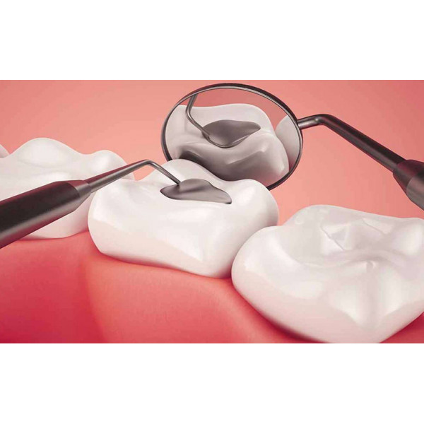 Điều trị sâu ngà răng phục hồi bằng Composite