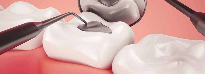 Điều trị sâu ngà răng phục hồi bằng Composite