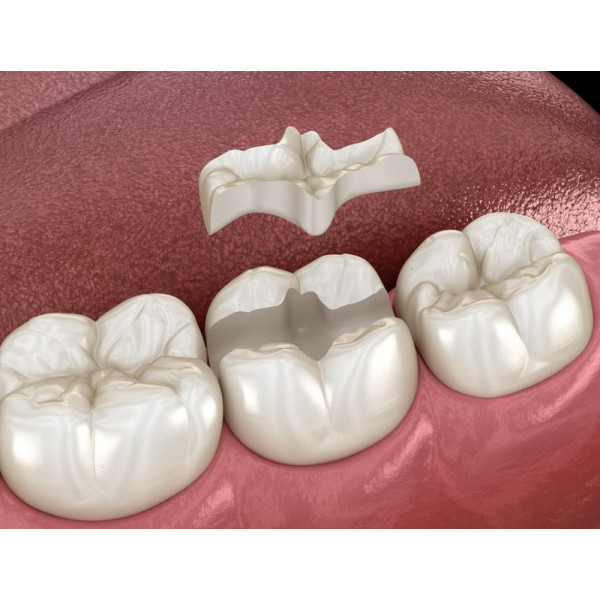 Inlay/Onlay sứ toàn phần: Bản chất và cơ chế