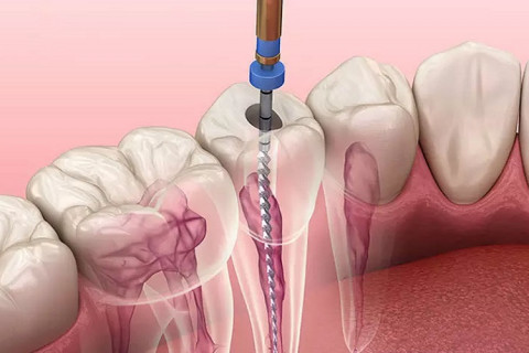 Lấy tủy buồng răng vĩnh viễn