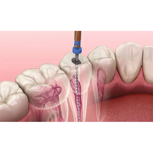 Lấy tủy buồng răng vĩnh viễn