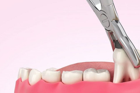 Nhổ răng khôn an toàn – Bác sĩ chuyên khoa, không đau, hồi phục nhanh