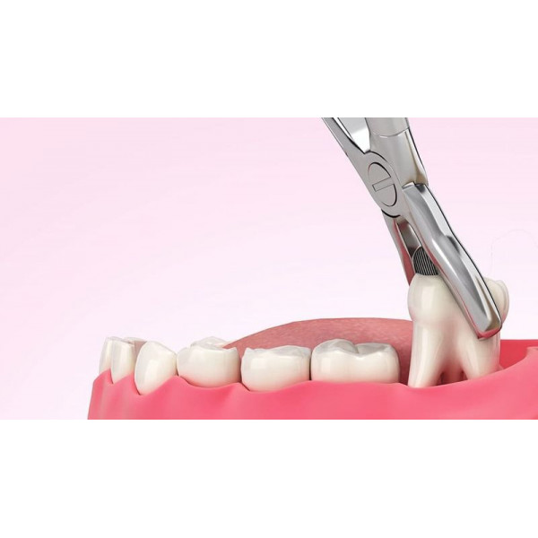 Nhổ răng khôn an toàn – Bác sĩ chuyên khoa, không đau, hồi phục nhanh