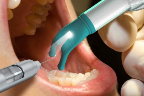 Giải pháp nhổ răng khôn nhẹ nhàng với công nghệ gây tê hiện đại