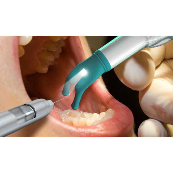 Giải pháp nhổ răng khôn nhẹ nhàng với công nghệ gây tê hiện đại