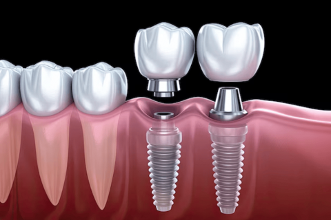 Phẫu thuật ghép xương nhân tạo để cấy ghép implant
