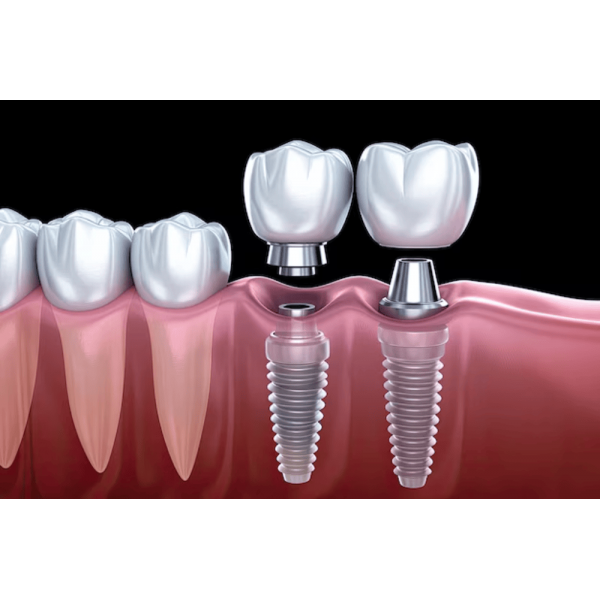 Phẫu thuật ghép xương nhân tạo để cấy ghép implant