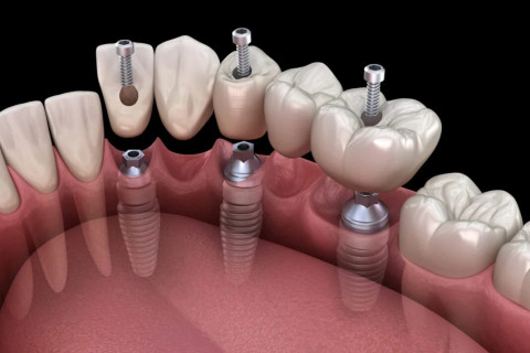 Chụp kim loại thường gắn bằng ốc vít trên Implant