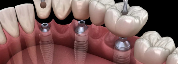 Chụp kim loại thường gắn bằng ốc vít trên Implant