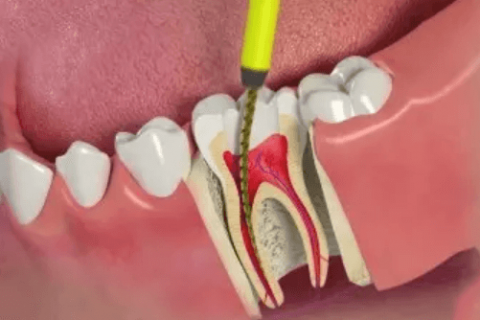 Giữ lại răng thật, loại bỏ cơn đau – Điều trị tủy an toàn, nhanh chóng