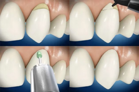 Phục hồi cổ răng bằng Composite