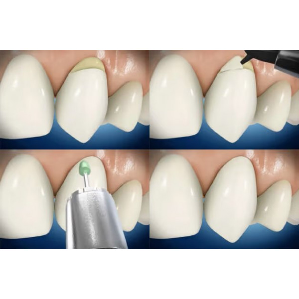 Phục hồi cổ răng bằng Composite