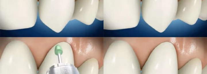 Phục hồi cổ răng bằng Composite