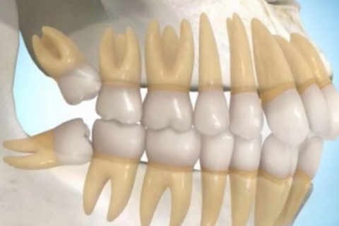 Cảnh báo răng khôn mọc ngầm - Nguy cơ viêm nhiễm xương hàm Cảnh báo răng khôn mọc ngầm - Nguy cơ viêm nhiễm xương hàm