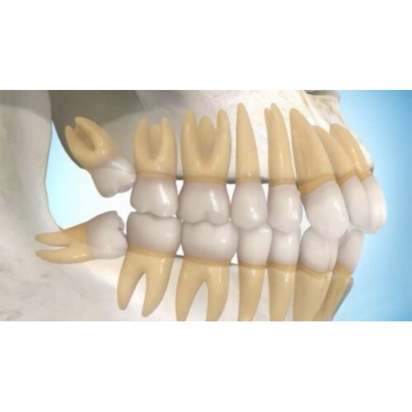Cảnh báo răng khôn mọc ngầm - Nguy cơ viêm nhiễm xương hàm