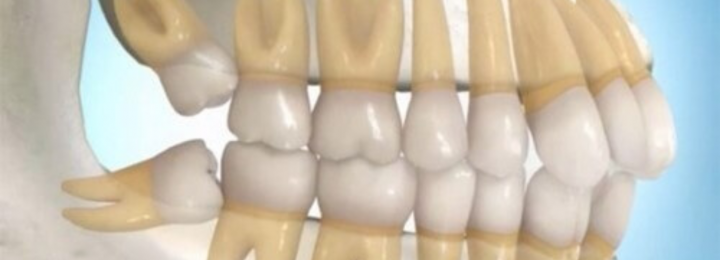 Cảnh báo răng khôn mọc ngầm - Nguy cơ viêm nhiễm xương hàm