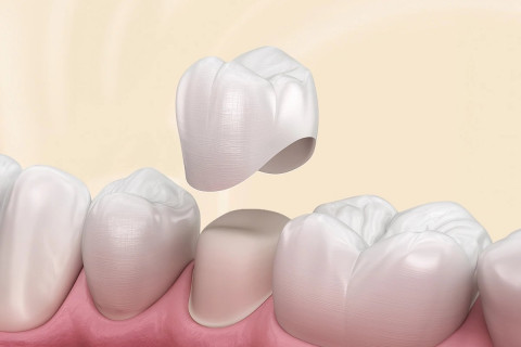 Răng sứ thẩm mỹ – giải pháp thay đổi diện mạo chỉ trong vài ngày