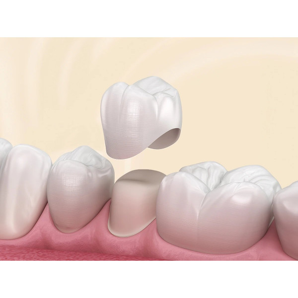 Bọc răng sứ toàn sứ – lựa chọn thông minh cho nụ cười bền đẹp