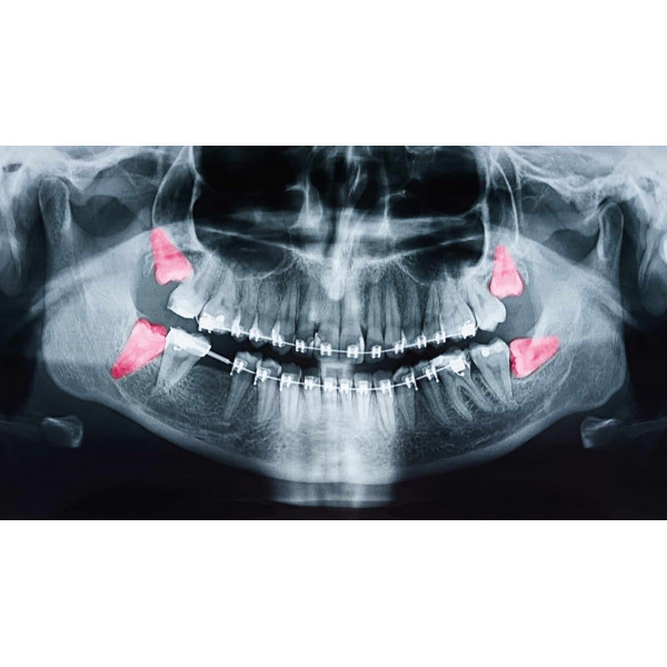 Phẫu thuật răng khôn mọc lệch: Đừng chờ đau mới điều trị!