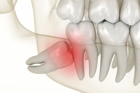 Răng khôn mọc lệch có nguy hiểm không? Câu trả lời từ bác sĩ