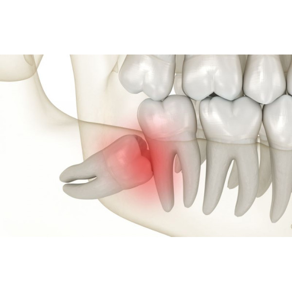 Răng khôn mọc lệch có nguy hiểm không? Câu trả lời từ bác sĩ