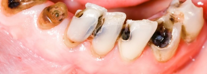 Sâu răng là bệnh phổ biến nhưng hoàn toàn có thể điều trị dứt điểm